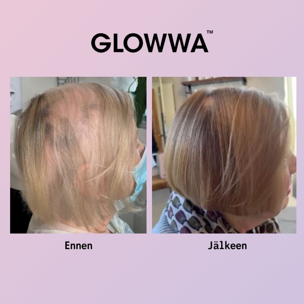 ennen ja jälkeen kuva kun glowwa ravintolisää on käytetty.
